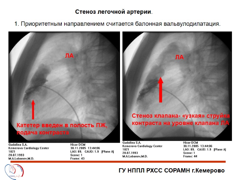ГУ НППЛ РХСС СОРАМН г.Кемерово Стеноз легочной артерии. 1. Приоритетным направлением считается балонная вальвулодилатация.